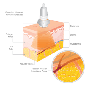 cavitation ellectrode