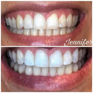 Teeth Whitening Vancouver Wa